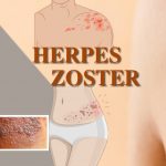 Herpes Zóster