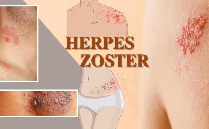 herpes zoster